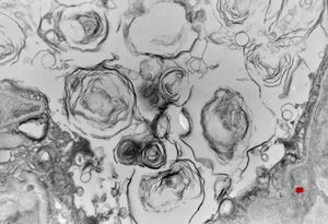 F, 2m. | surfactant deficiency F, 2m. | surfactant deficiency